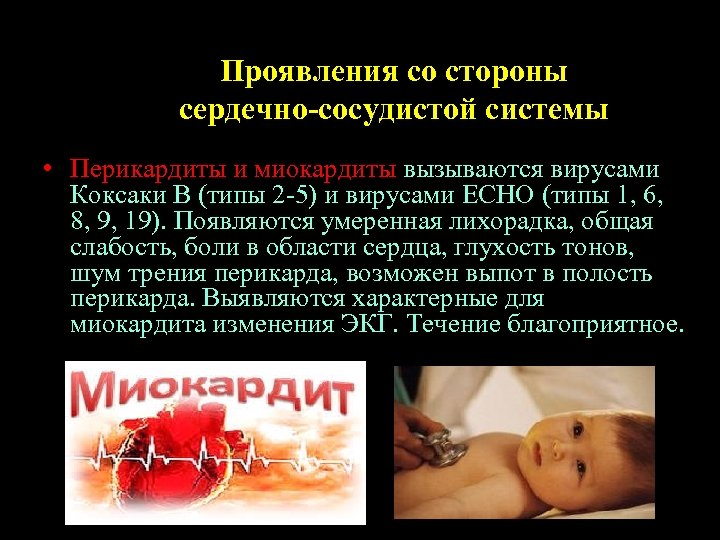 Проявления со стороны сердечно-сосудистой системы • Перикардиты и миокардиты вызываются вирусами Коксаки В (типы