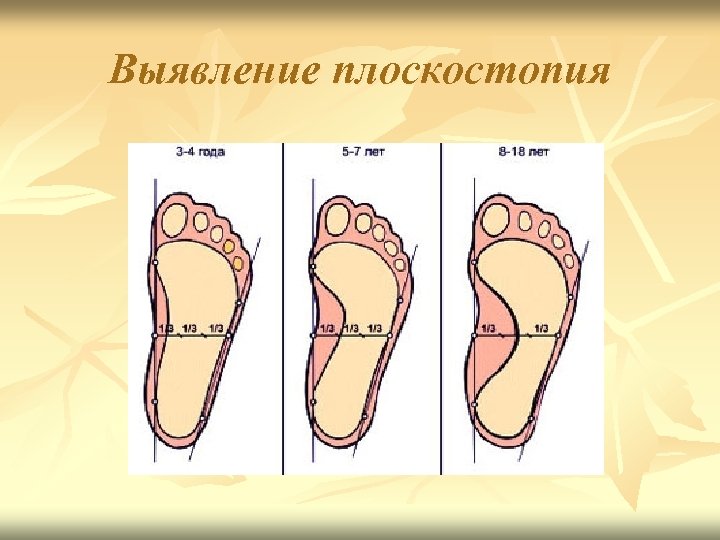 Выявление плоскостопия 