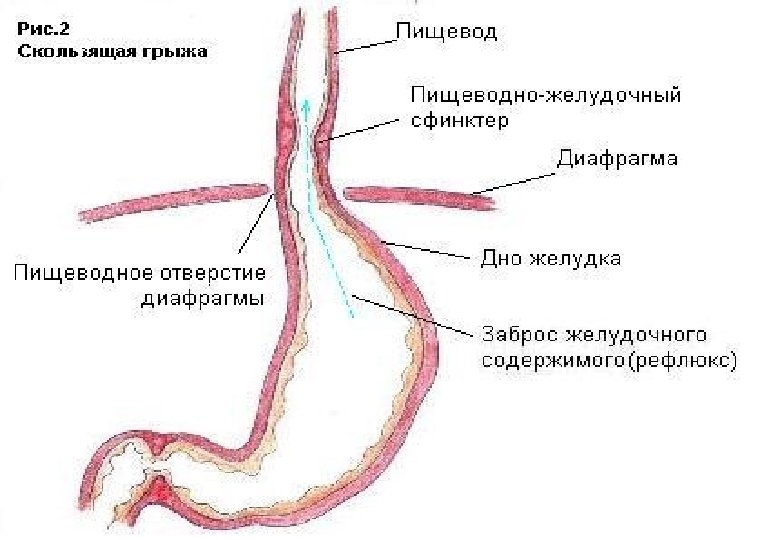 Симптомы грыжи пищевода. Скользящая грыжа пищевода. Анатомия пищеводно-желудочного соединения. Скользящие и параэзофагеальные грыжи пищеводного отверстия.