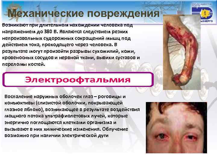 Механические повреждения Возникают при длительном нахождении человека под напряжением до 380 В. Являются следствием