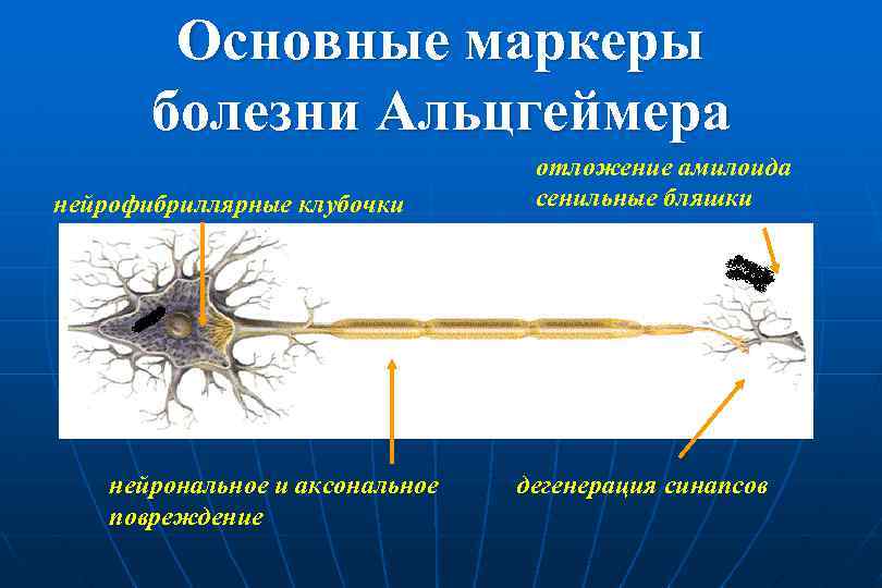 Основные маркеры болезни Альцгеймера нейрофибриллярные клубочки нейрональное и аксональное повреждение отложение амилоида сенильные бляшки