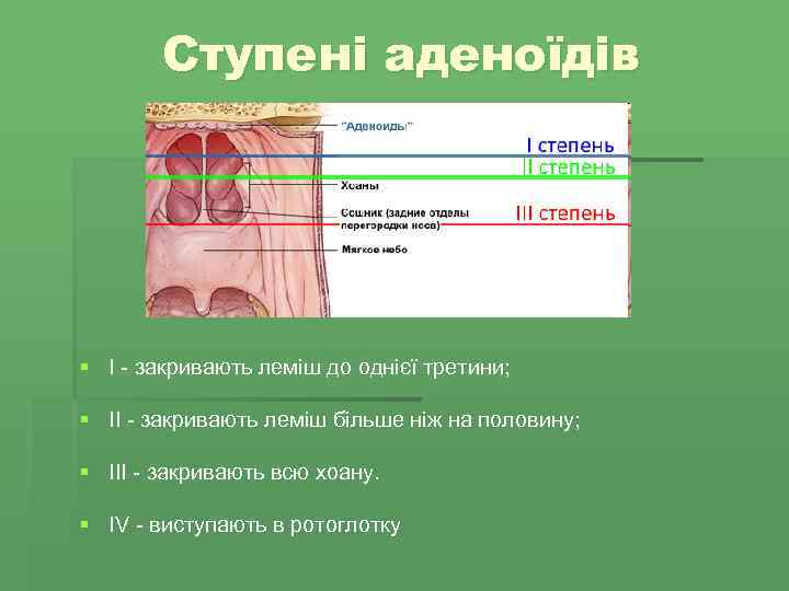 Ступені аденоїдів § І - закривають леміш до однієї третини; § ІІ - закривають
