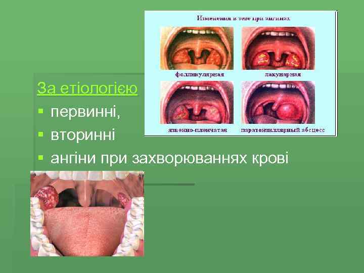 За етіологією § первинні, § вторинні § ангіни при захворюваннях крові 