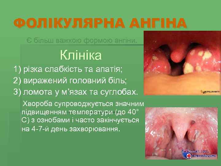 ФОЛІКУЛЯРНА АНГІНА Є більш важкою формою ангіни. Клініка 1) різка слабкість та апатія; 2)