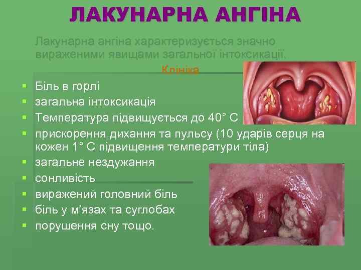 ЛАКУНАРНА АНГІНА § § § § § Лакунарна ангіна характеризується значно вираженими явищами загальної