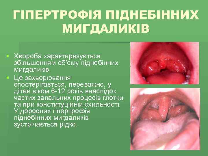 ГІПЕРТРОФІЯ ПІДНЕБІННИХ МИГДАЛИКІВ § Хвороба характеризується збільшенням об’єму піднебінних мигдаликів. § Це захворювання спостерігається,