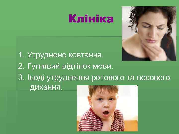 Клініка 1. Утруднене ковтання. 2. Гугнявий відтінок мови. 3. Іноді утруднення ротового та носового