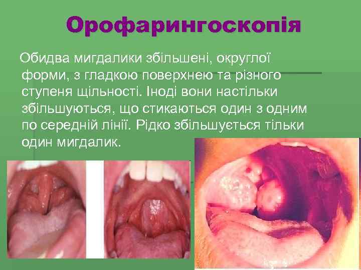 Орофарингоскопія Обидва мигдалики збільшені, округлої форми, з гладкою поверхнею та різного ступеня щільності. Іноді