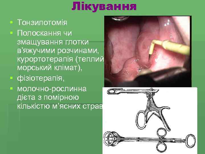 Лікування § Тонзилотомія § Полоскання чи змащування глотки в’яжучими розчинами, курортотерапія (теплий морський клімат),