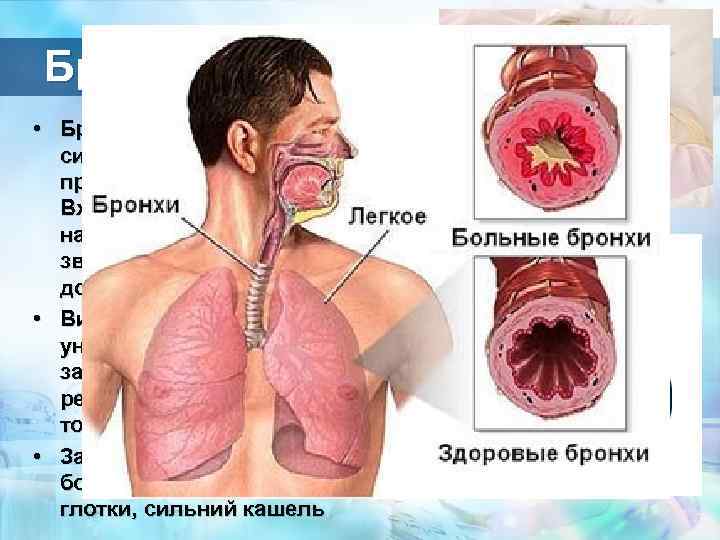 Бронхіт • Бронхіт- захворювання дихальної системи , при якому в запальний процес втягуються бронхи.