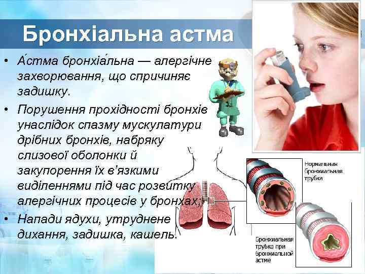Бронхіальна астма • А стма бронхіа льна — алергічне захворювання, що спричиняє задишку. •