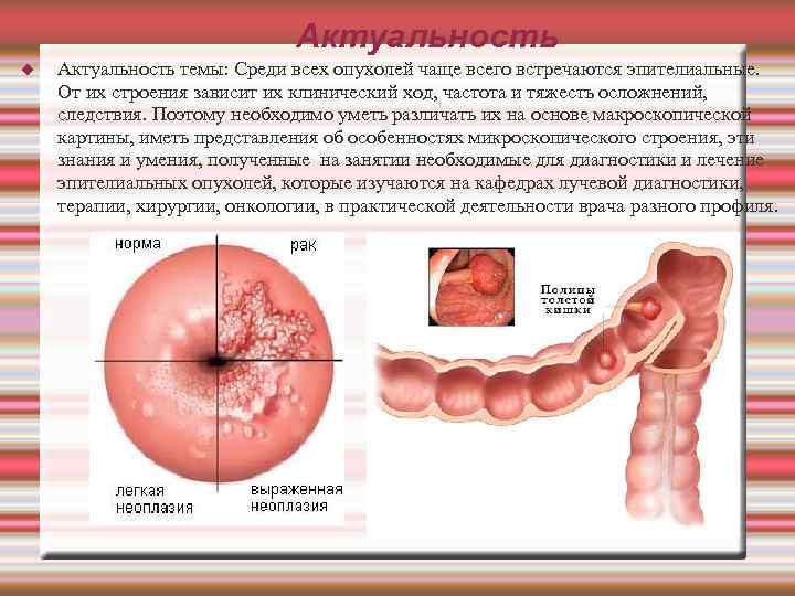 Актуальность темы: Среди всех опухолей чаще всего встречаются эпителиальные. От их строения зависит их