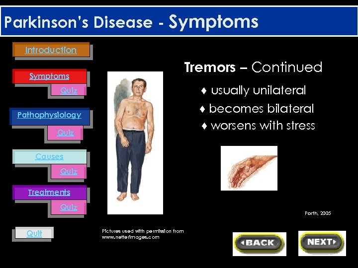 Parkinson’s Disease - Symptoms Introduction Tremors – Continued Symptoms ♦ usually unilateral Quiz ♦