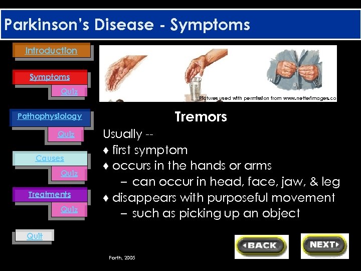 Parkinson’s Disease - Symptoms Introduction Symptoms Quiz Pictures used with permission from www. netterimages.