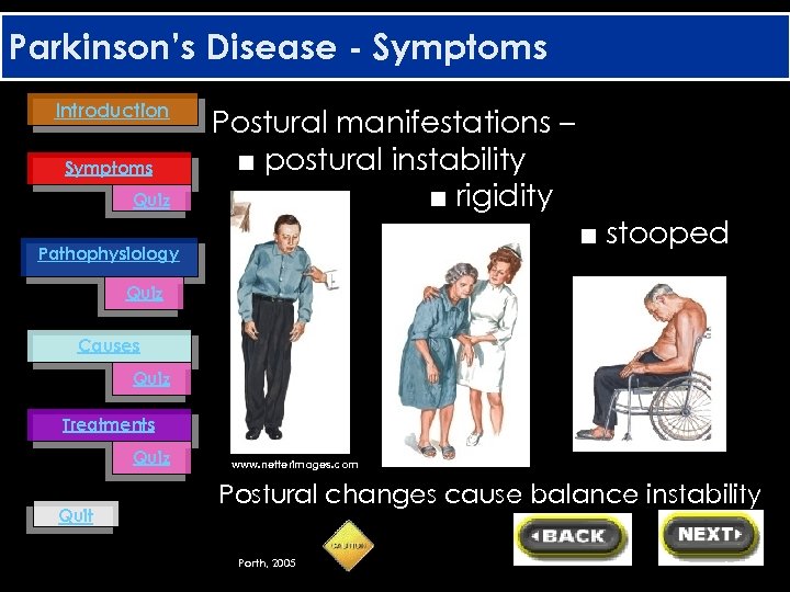 Parkinson’s Disease - Symptoms Introduction Symptoms Quiz Postural manifestations – ■ postural instability ■