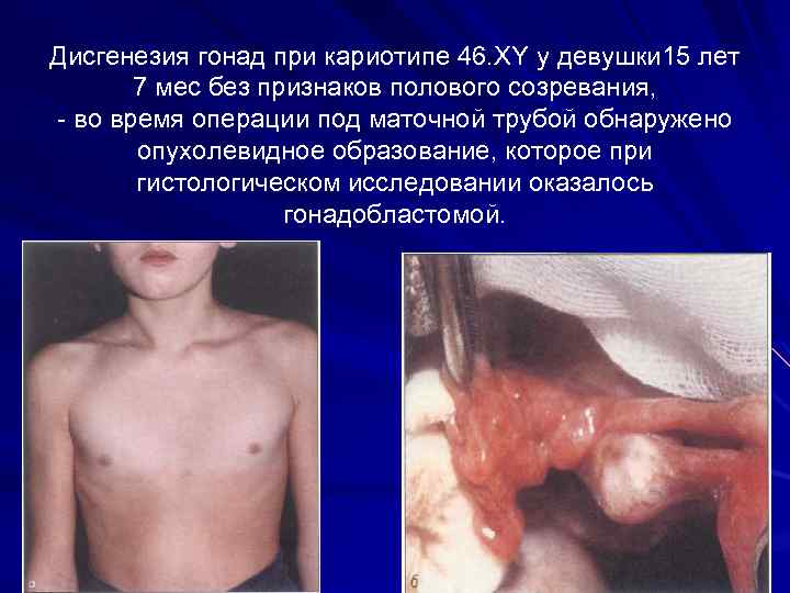 Дисгенезия гонад при кариотипе 46. XY у девушки 15 лет 7 мес без признаков