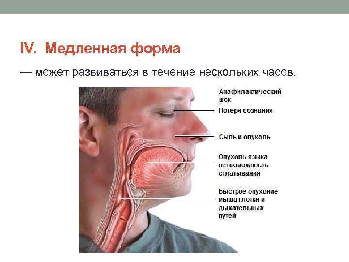 ІV.  Медленная форма — может развиваться в течение нескольких часов. 