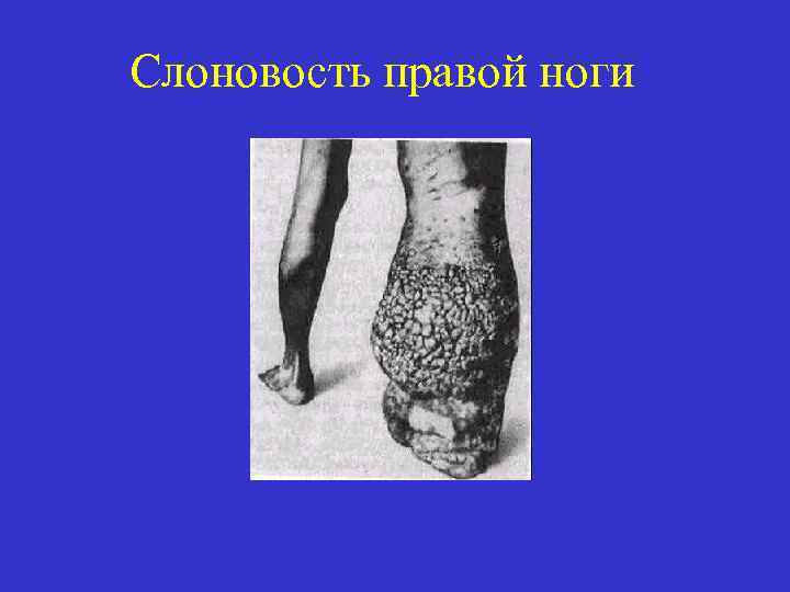 Слоновость правой ноги 