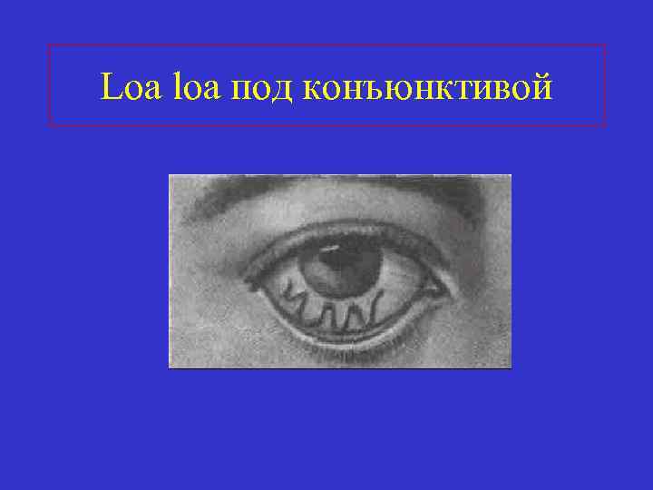 Loa loa под конъюнктивой 