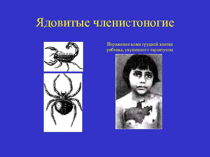Ядовитые членистоногие Поражение кожи грудной клетки ребенка, укушенного тарантулом 