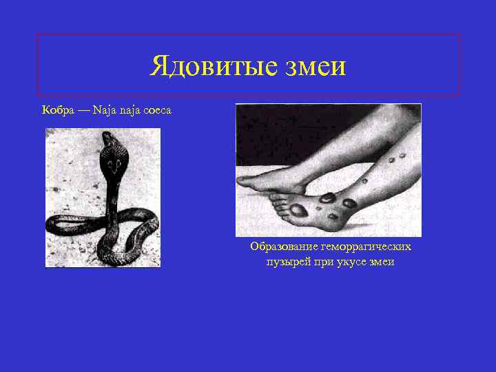 Ядовитые змеи Кобра — Naja naja coeca Образование геморрагических пузырей при укусе змеи 
