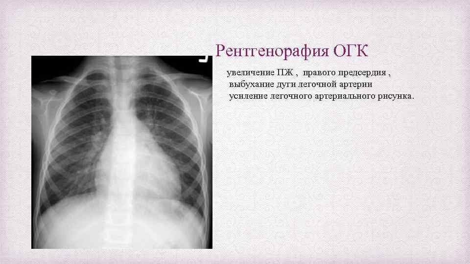 Рентгенорафия ОГК увеличение ПЖ , правого предсердия , выбухание дуги легочной артерии усиление легочного