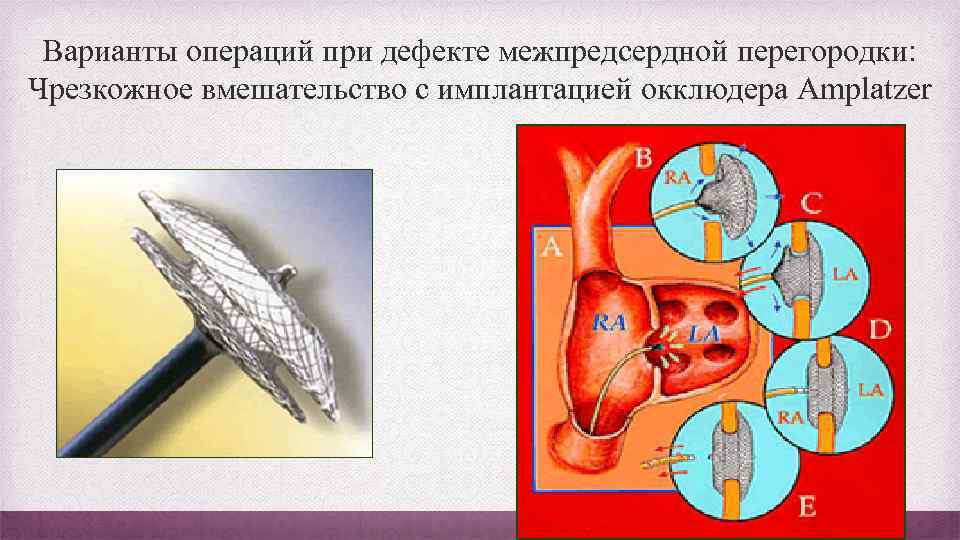 Варианты операций при дефекте межпредсердной перегородки: Чрезкожное вмешательство с имплантацией окклюдера Amplatzer 