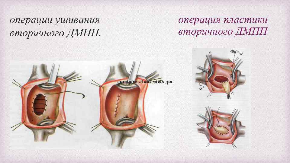 операция пластики вторичного ДМПП операции ушивания вторичного ДМПП. синдром Лютембахера 