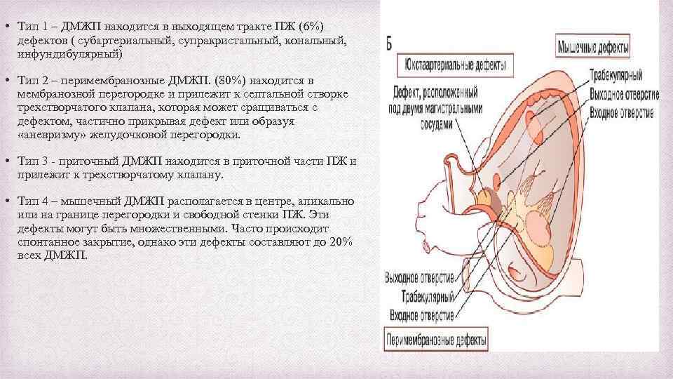  • Тип 1 – ДМЖП находится в выходящем тракте ПЖ (6%) дефектов (