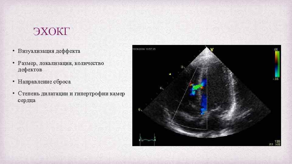 ЭХОКГ • Визуализация деффекта • Размер, локализация, количество дефектов • Направление сброса • Степень
