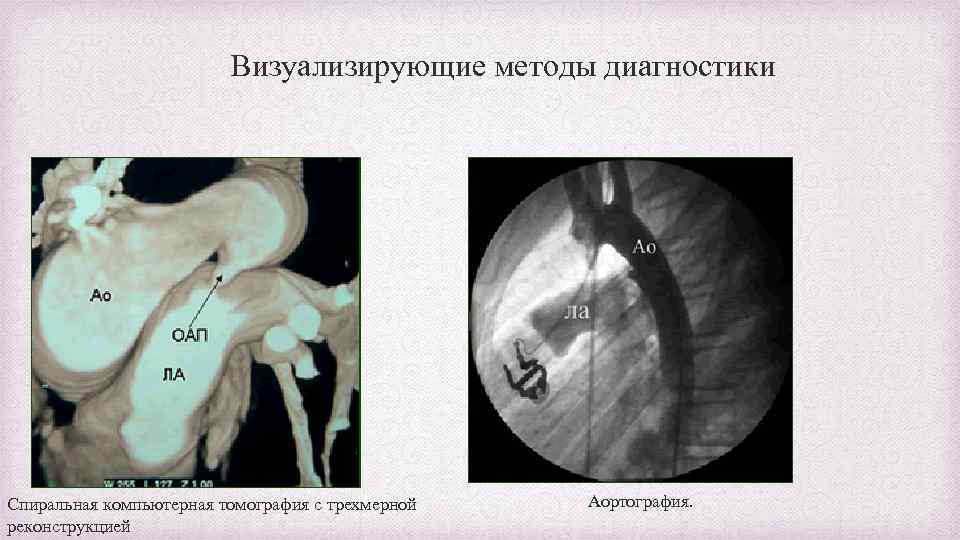 Визуализирующие методы диагностики Спиральная компьютерная томография с трехмерной реконструкцией Аортография. 