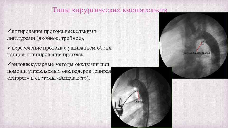 Типы хирургических вмешательств üлигирование протока несколькими лигатурами (двойное, тройное), üпересечение протока с ушиванием обоих