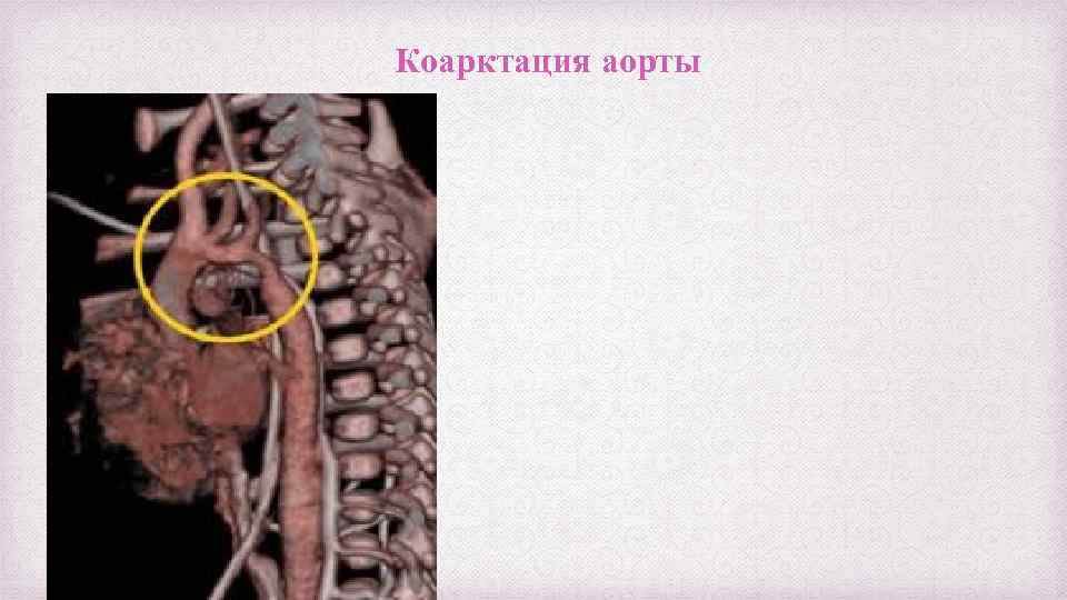 Коарктация аорты 