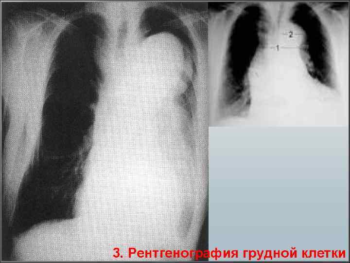 Аневризма грудной аорты фото