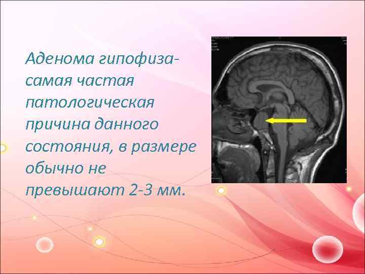 Аденома гипофиза- самая частая патологическая причина данного состояния, в размере обычно не превышают 2