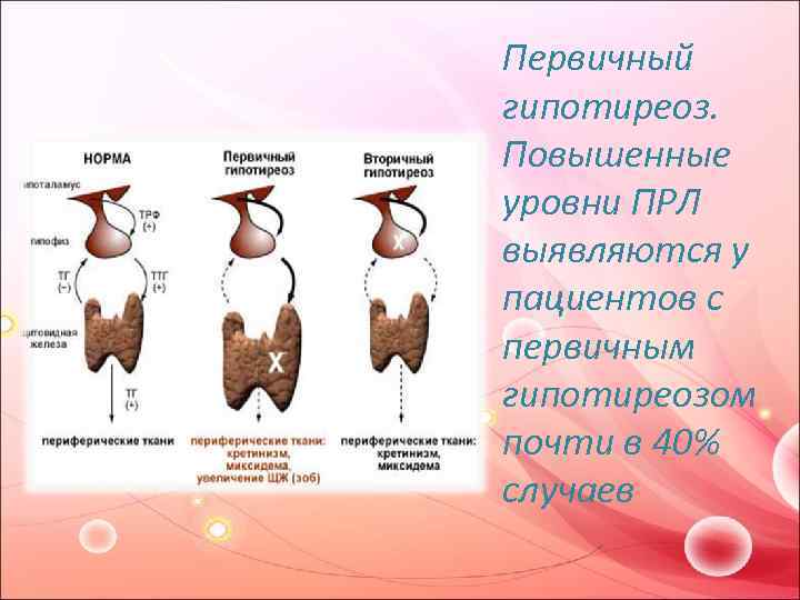 Первичный гипотиреоз. Повышенные уровни ПРЛ выявляются у пациентов с первичным гипотиреозом почти в 40%