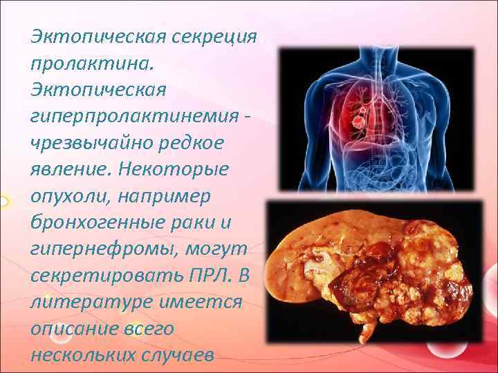 Эктопическая секреция пролактина. Эктопическая гиперпролактинемия - чрезвычайно редкое явление. Некоторые опухоли, например бронхогенные раки
