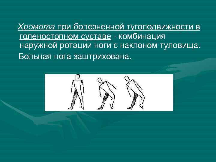 Хромота при болезненной тугоподвижности в голеностопном суставе - комбинация наружной ротации ноги с наклоном