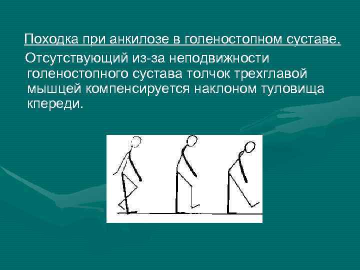 Походка при анкилозе в голеностопном суставе. Отсутствующий из-за неподвижности голеностопного сустава толчок трехглавой мышцей