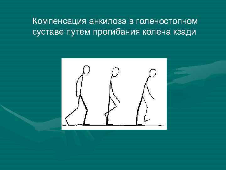 Компенсация анкилоза в голеностопном суставе путем прогибания колена кзади 