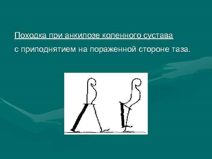 Походка при анкилозе коленного сустава с приподнятием на пораженной стороне таза. 