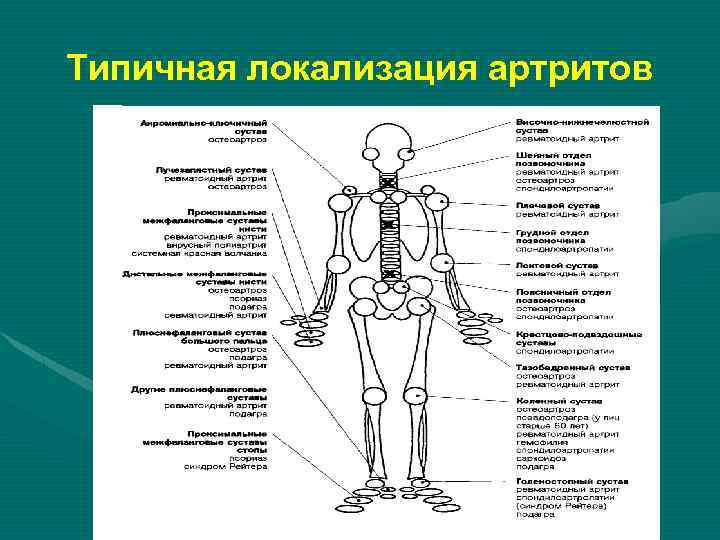 Артрит схема