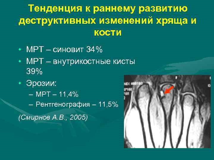 Тенденция к раннему развитию деструктивных изменений хряща и кости • МРТ – синовит 34%