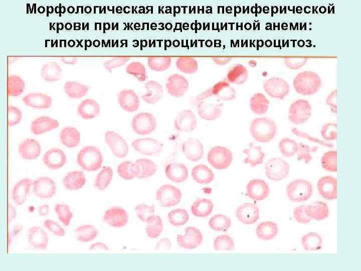 Гипохромия железодефицитная анемия. Морфологическая картина крови при железодефицитной анемии. Картина периферической крови при железодефицитной анемии. Железодефицитная анемия мазки крови. Железодефицитная анемия мазок крови.