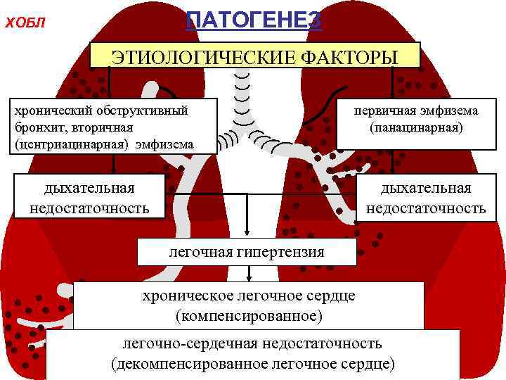 ПАТОГЕНЕЗ ХОБЛ ЭТИОЛОГИЧЕСКИЕ ФАКТОРЫ хронический обструктивный бронхит, вторичная (центриацинарная) эмфизема первичная эмфизема (панацинарная) дыхательная