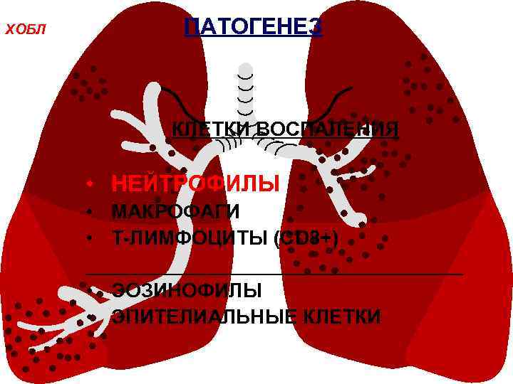 ХОБЛ ПАТОГЕНЕЗ КЛЕТКИ ВОСПАЛЕНИЯ • НЕЙТРОФИЛЫ • МАКРОФАГИ • Т-ЛИМФОЦИТЫ (СD 8+) _________________ •