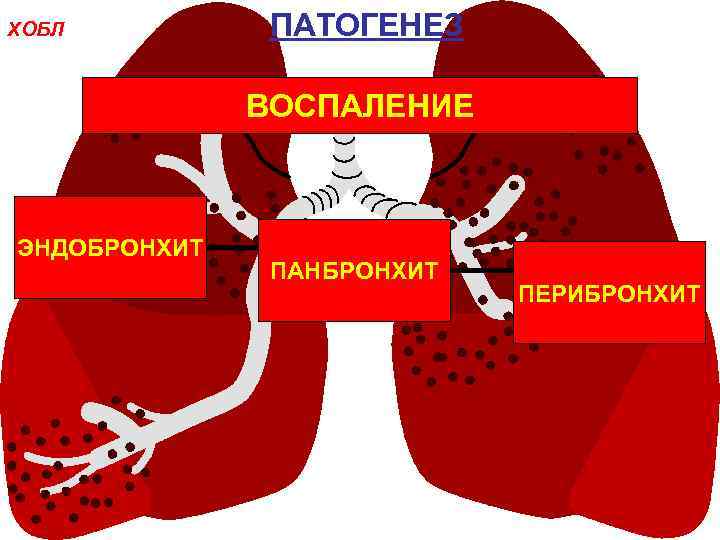 ХОБЛ ПАТОГЕНЕЗ ВОСПАЛЕНИЕ ЭНДОБРОНХИТ ПАНБРОНХИТ ПЕРИБРОНХИТ 