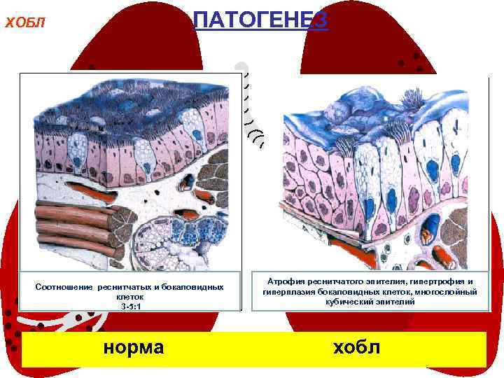 ПАТОГЕНЕЗ ХОБЛ Соотношение реснитчатых и бокаловидных клеток 3 -5: 1 норма Атрофия реснитчатого эпителия,