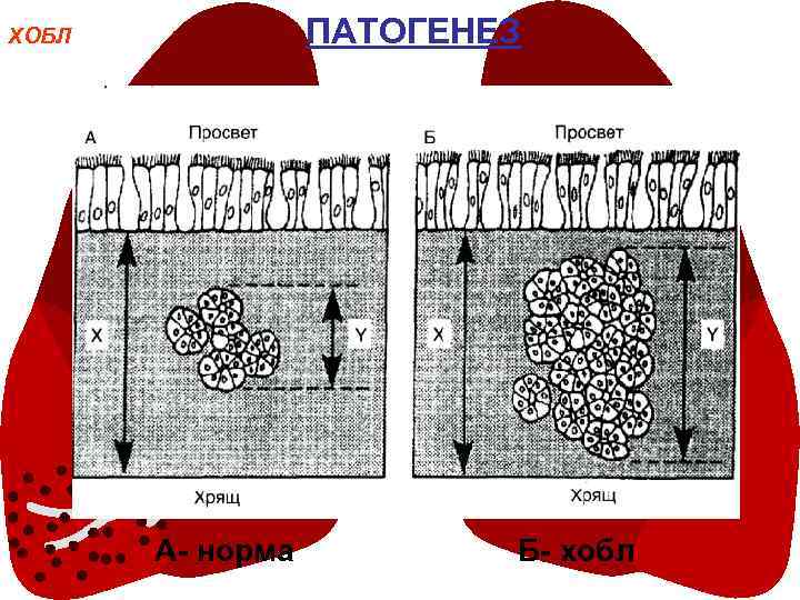 ПАТОГЕНЕЗ ХОБЛ А- норма Б- хобл 