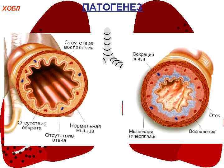 Легкие при хобл картинки